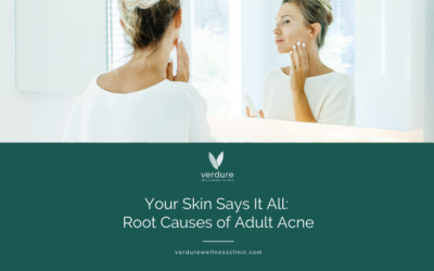 Your Skin Says it All: Root Causes of Adult Acne