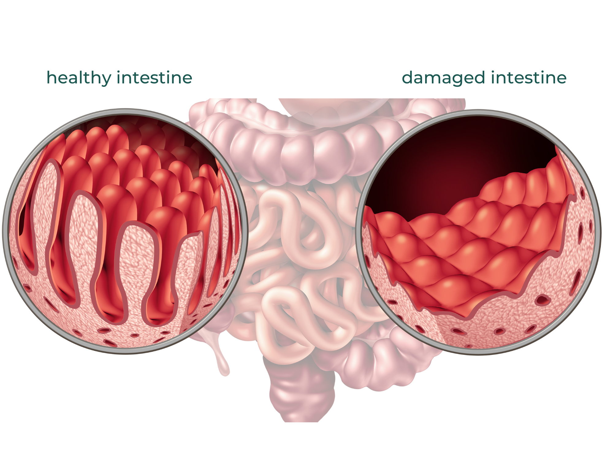 small intestine SIBO gastrointestinal autoimmune disease IBD celiac